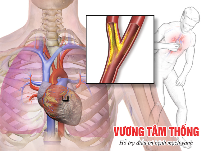 Cơn đau thắt ngực xảy ra khi động mạch vành bị cứng và tắc hẹp.png